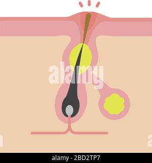 Section transversale des pores ( progression de l'acné) / Whitehead Illustration de Vecteur