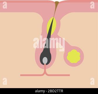 Section transversale des pores ( progression de l'acné) / pore bouché Illustration de Vecteur