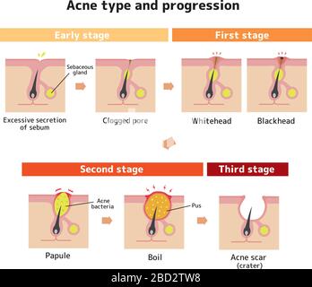Types d'acné et illustration de progression Illustration de Vecteur