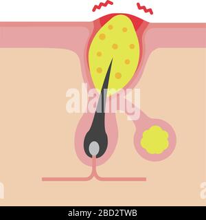 Section transversale des pores ( progression de l'acné) / papule Illustration de Vecteur