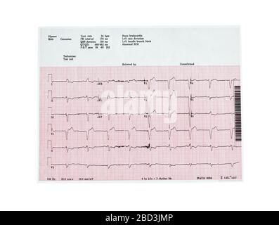 Rapport d'écocardiographie (ECG) montrant des battements cardiaques irréguliers isolés en blanc Banque D'Images