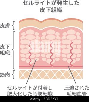 Illustration de la vue en coupe de la peau de cellulite Illustration de Vecteur