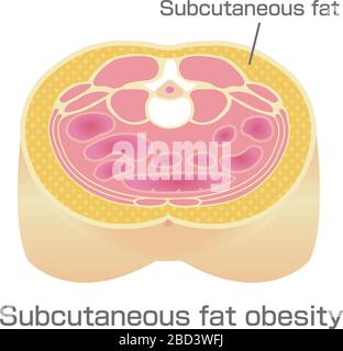 Type d'illustration de l'obésité . Vue en coupe abdominale (graisse sous-cutanée). Illustration de Vecteur