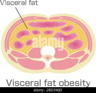 Type d'illustration de l'obésité . Vue en coupe abdominale (graisse viscérale ). Illustration de Vecteur