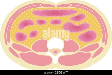 Type d'illustration de l'obésité . Vue en coupe abdominale (graisse viscérale ). Illustration de Vecteur