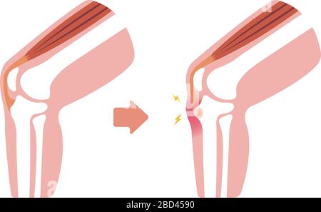 Illustration de la maladie d'Osgood-schdernier (maladie de l'articulation du genou) Illustration de Vecteur