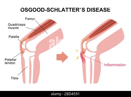 Illustration de la maladie d'Osgood-schdernier (maladie de l'articulation du genou) Illustration de Vecteur