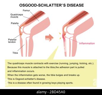 Illustration de la maladie d'Osgood-schdernier (maladie de l'articulation du genou) Illustration de Vecteur