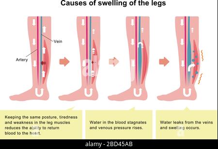 Cause de gonflement (œdème) des jambes. Illustration plate Illustration de Vecteur