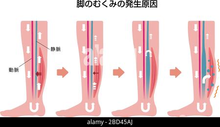 Cause de gonflement (œdème) des jambes. Illustration plate Illustration de Vecteur