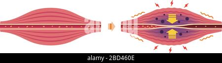 Cause de la raideur musculaire et illustration de la douleur Illustration de Vecteur
