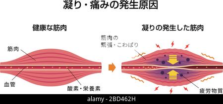Cause de la raideur musculaire et illustration de la douleur Illustration de Vecteur