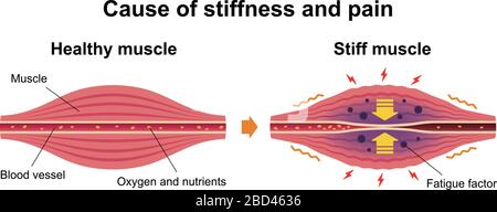 Cause de la raideur musculaire et illustration de la douleur Illustration de Vecteur