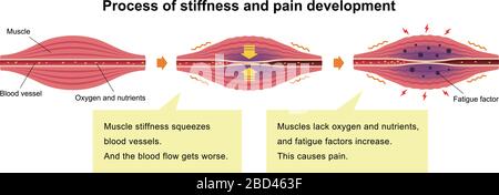 Cause de la raideur musculaire et illustration de la douleur (3 étapes) Illustration de Vecteur