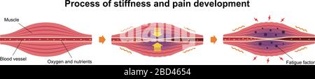 Cause de la raideur musculaire et illustration de la douleur (3 étapes) Illustration de Vecteur