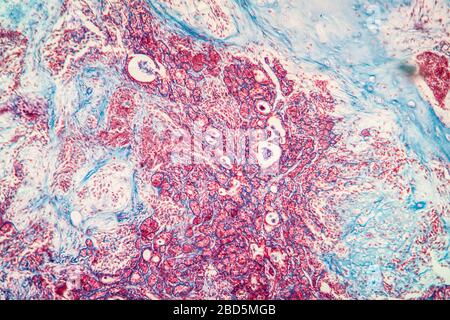 Fibroépithélium tissu malade 100 fois Banque D'Images