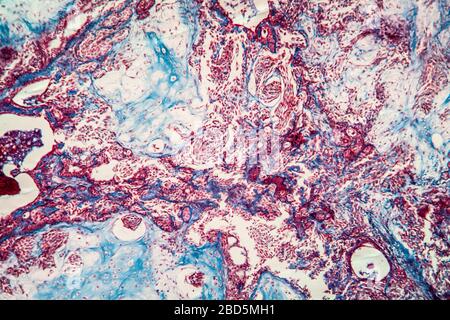 Fibroépithélium tissu malade 100 fois Banque D'Images