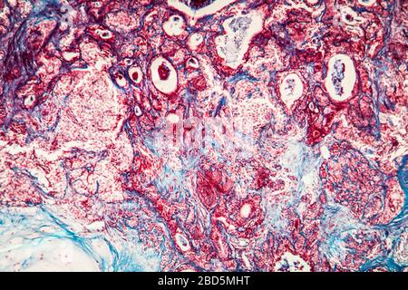 Fibroépithélium tissu malade 100 fois Banque D'Images