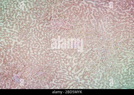 Tissu d'hémosidérose sous le microscope 100 fois Banque D'Images