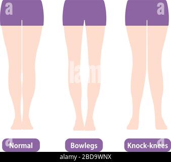 Différence types d'angles des jambes et illustration vectorielle des genoux . Normal, jambes basses, genoux-fesses. Illustration de Vecteur