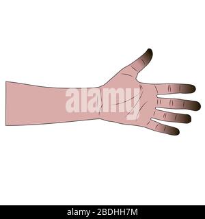 main mâle de dessin animé avec des traces de gelures conséquences. fond blanc isolé illustration vectorielle de stock Illustration de Vecteur