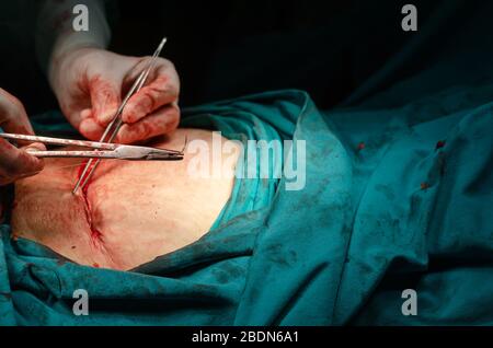 Un chirurgien est un assemblage blessure après une opération dans un hôpital Banque D'Images