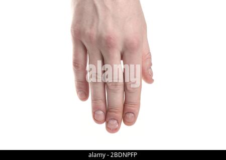 Gros plan sur l'infection des champignons des ongles. Infection fongique sur la main des ongles, doigt avec onychomycose, dommages sur la main humaine. Banque D'Images