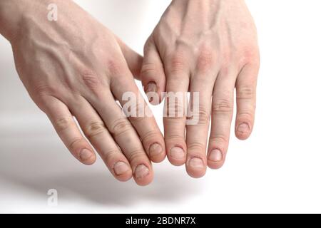 Gros plan sur l'infection des champignons des ongles. Infection fongique sur la main des ongles, doigt avec onychomycose, dommages sur la main humaine. Banque D'Images