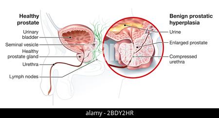 Illustration montrant une hyperplasie bénigne de la prostate et de la prostate (HBP), une prostate agrandie avec la vessie, l'urètre et la vésicule séminale Banque D'Images