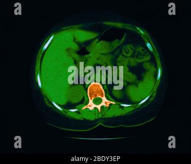 La scoliose, Granulome & la calcification dans Lung Banque D'Images