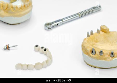 le processus de fabrication des dents en céramique sur les implants. implants dentaires avec dents en céramique sur fond clair. concept d'implantation dentaire et d Banque D'Images