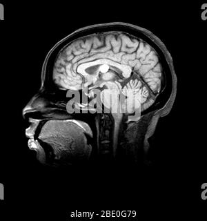 Kyste du côlon IRM du troisième ventricule. Banque D'Images