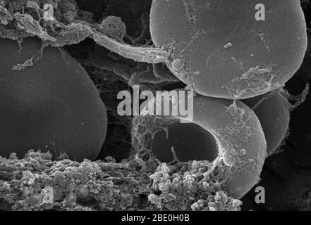 Ce micrographe électronique à balayage (SEM) a représenté un certain nombre de globules rouges qui se sont enmaillés dans une matrice fibreuse sur la surface luminale d'un cathéter vasculaire à endage; Agrandissement 11432x Notez la forme cytomorphologique biconvexe de chaque érythrocyte, qui augmente la surface de ces cellules remplies d'hémoglobine, favorisant ainsi un plus grand degré d'échange de gaz, qui est leur fonction principale dans un cadre in vivo. Dans leur phase adulte, ces cellules ne possèdent pas de noyau. Ce qui semble être des morceaux de débris de forme irrégulière, sont en fait des oreillons de fibrine, qui quand à l'intérieur de l'organi vivant Banque D'Images