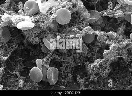 Ce micrographe électronique à balayage (SEM) a représenté un certain nombre de globules rouges qui se sont enmaillés dans une matrice fibreuse sur la surface luminale d'un cathéter vasculaire à endage; il a été agrandi 2858 fois. Notez la forme cytomorphologique biconvexe de chaque érythrocyte, qui augmente la surface de ces cellules remplies d'hémoglobine, favorisant ainsi un plus grand degré d'échange de gaz, qui est leur fonction principale dans un cadre in vivo. Dans leur phase adulte, ces cellules ne possèdent pas de noyau. Ce qui semble être des morceaux de débris de forme irrégulière, sont en fait des oreillons de fibrine, qui quand à l'intérieur de l'organi vivant Banque D'Images