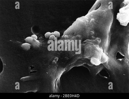 Étape quatre d'une séquence en six étapes de la mort d'une cellule cancéreuse. La cellule commence à arrondir et perd ses pics lorsque la cellule macrophage devient lisse. Agrandissement de la photo : 26 000 fois Banque D'Images