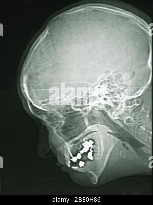 IRM montrant les sinus d'une femme de 54 ans. L’IRM est normale. Banque D'Images