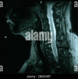 IRM de la colonne cervicale à partir de la jonction crânioinvertébrés vers le bas niveau de T3-T4. L'épaisseur de coupe IRM est DE 5,0 MM. L'IRM montre une maladie dégénérative des disques à 5-6 et 6-7 avec des ostéophytes postérieurs aux deux niveaux, provoquant un léger rétrécissement du canal spinal, particulièrement à 5-6. Banque D'Images