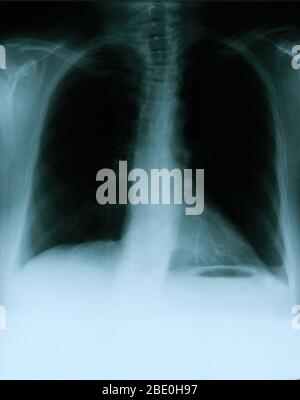 Radiographie montrant une vue frontale de la poitrine d'une femme de 54 ans. La radiographie montre un nœud lymphatique hilaire gauche calcifié qui résulte probablement d'une maladie granulomateuse antérieure. On remarque également une zone vague de densité accrue dans l'aspect latéral de l'apex droit et une déformation scoliotique légère de la colonne vertébrale dorsale. Banque D'Images