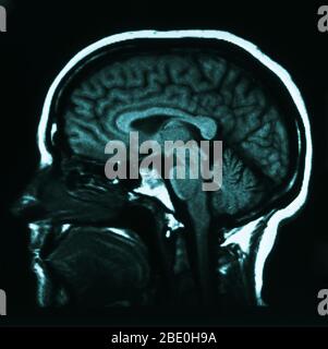 IRM sagittale pondérée en T (du côté) montrant l'anatomie normale du cerveau, y compris : le cortex cérébral, le corps callosum, le thalamus, l'oblongata de la médulla, le cervelet et le tronc cérébral. Banque D'Images