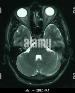 IRM du cerveau (vue axiale) d'un homme de 26 ans. L'IRM a été prise à la suite de blessures à la tête dans un accident de voiture. Le diagnostic de l'IRM est un petit kyste arachnoïde dans la région frontale antérieure gauche paraparasagittale. Le kyste n'est pas vu dans cette vue particulière puisqu'il est en dessous de la région affectée. Tous les autres aspects semblent normaux. Banque D'Images