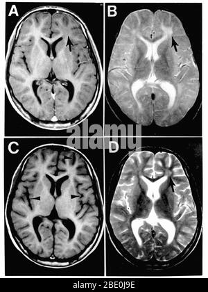 Panencéphalite sclérosante subaiguë (complication de l'infection par la rougeole). Figure 1. IRM du cerveau au moment de la présentation dans la clinique de neurologie (A et B) et 3 mois plus tard (C et D). Les panneaux A et C sont des images pondérées en fonction du poids de la valeur de T 1 ; les panneaux B et D sont des images pondérées en fonction du poids de T 2. L'acquisition IRM initiale (A et B) révèle une anomalie focale dans la matière blanche sous-corticale du lobe frontal gauche, consistant en un signal hypointense sur l'image pondérée en T (flèche en A) et un signal hyperintense sur l'image pondérée en T (flèche en B). Dans l'acquisition de suivi, l'anomalie focale dans le lobe frontal gauche est l Banque D'Images