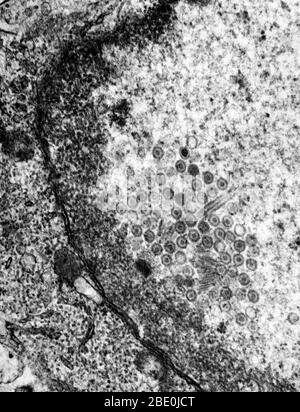 Transmission Electron micrographe (TEM) révélant la présence de nombreux virions d'herpès simplex de type 2. L'herpès génital est une infection génitale causée par le virus de l'herpès simplex (HSV). La plupart des personnes qui portent de l'herpès ne savent pas qu'elles ont été infectées et beaucoup ne subiront jamais une éclosion, qui implique des ampoules semblables aux blessures froides. Bien qu'il n'y ait pas de remède à l'herpès, les symptômes au fil du temps sont de plus en plus doux et les éclosions sont de plus en plus fréquentes. La manifestation typique d'une infection primaire est des grappes de sores génitales composées de papules et vésicules enflammés sur la surface externe Banque D'Images