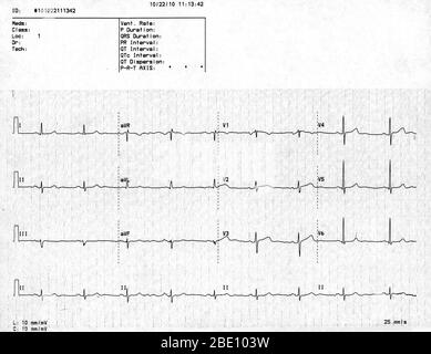 Électrocardiogramme normal (EKG) d'une femme de 60 ans. Banque D'Images