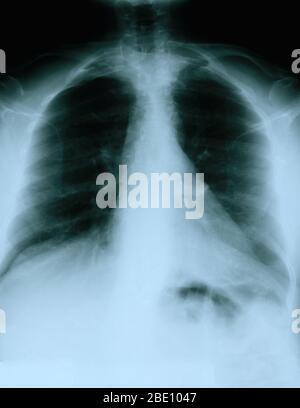 Radiographie montrant une vue frontale de la poitrine d'une femme de 54 ans. La radiographie montre un nœud lymphatique hilaire gauche calcifié qui résulte probablement d'une maladie granulomateuse antérieure. On remarque également une zone vague de densité accrue dans l'aspect latéral de l'apex droit et une déformation scoliotique légère de la colonne vertébrale dorsale. Banque D'Images