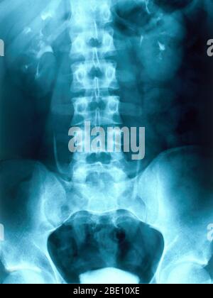 Radiographie montrant les reins humains normaux. La fonction principale des reins est de maintenir l'équilibre homéostatique des fluides corporels. Banque D'Images