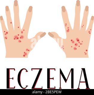 Eczéma. Peau malade. Mains douloureux. Affiche médicale. Illustration de Vecteur