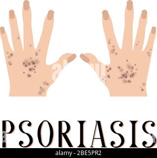 Psoriasis. Peau malade. Mains douloureux. Affiche médicale. Dermatologie et vénéréologie. Illustration de Vecteur