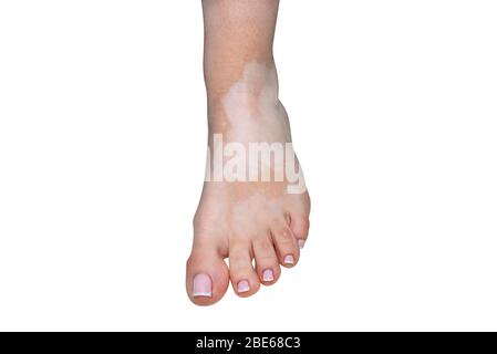 Taches de la maladie de vitiligo sur le pied gauche dans une jeune femme caucasienne, isolée sur un fond blanc avec un chemin de découpe. Banque D'Images