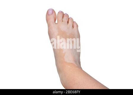 Taches de la maladie de vitiligo sur le pied droit dans une jeune femme caucasienne, isolée sur un fond blanc avec un chemin de coupure. Banque D'Images