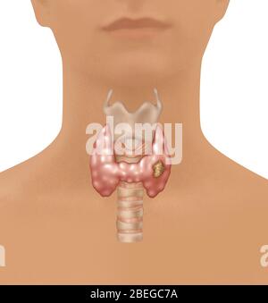 Illustration montrant l'emplacement du larynx, de la glande thyroïde et de la trachée dans une figure femelle. Une croissance maligne peut être observée dans la partie inférieure droite de la thyroïde. Banque D'Images